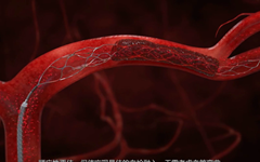 高瓴、红杉纷纷押注的神经介入赛道，能否复制心血管介入成功【神经介入专题】